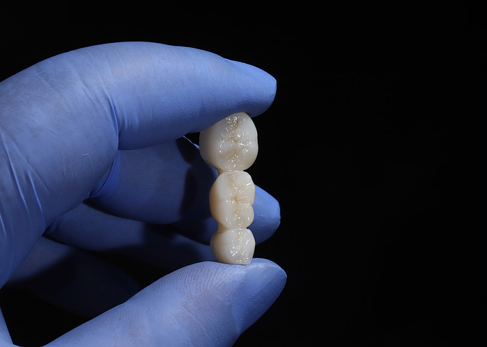 Dental Bridges