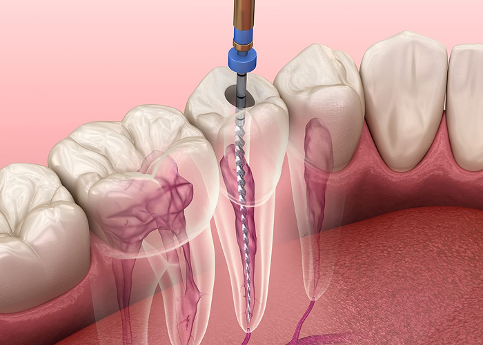 Root Canals