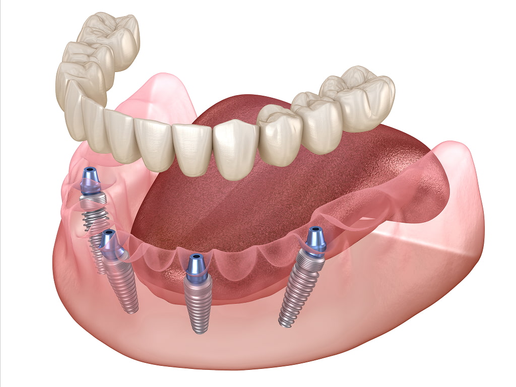Full Smile Makeover