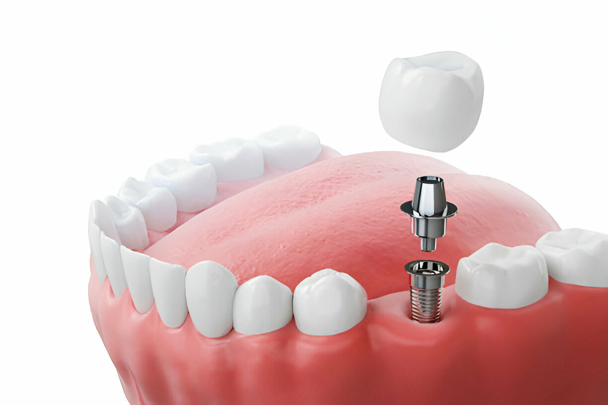 Restore Your Confidence with Dental Implants at Main Street Dentistry in Tupelo, MS_FI
