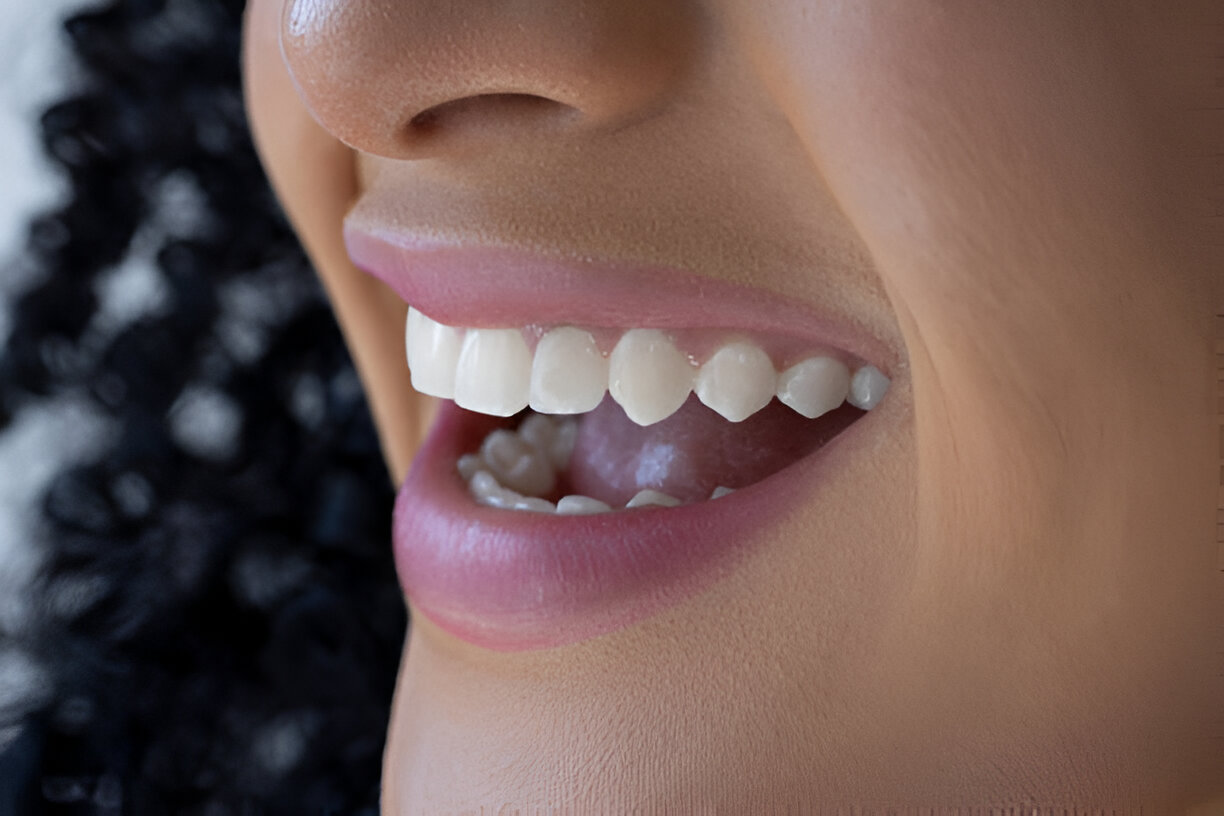 Achieve Your Perfect Smile with Emax Veneers: Expert Care at Main Street Dentistry in Tupelo, Mississippi_FI