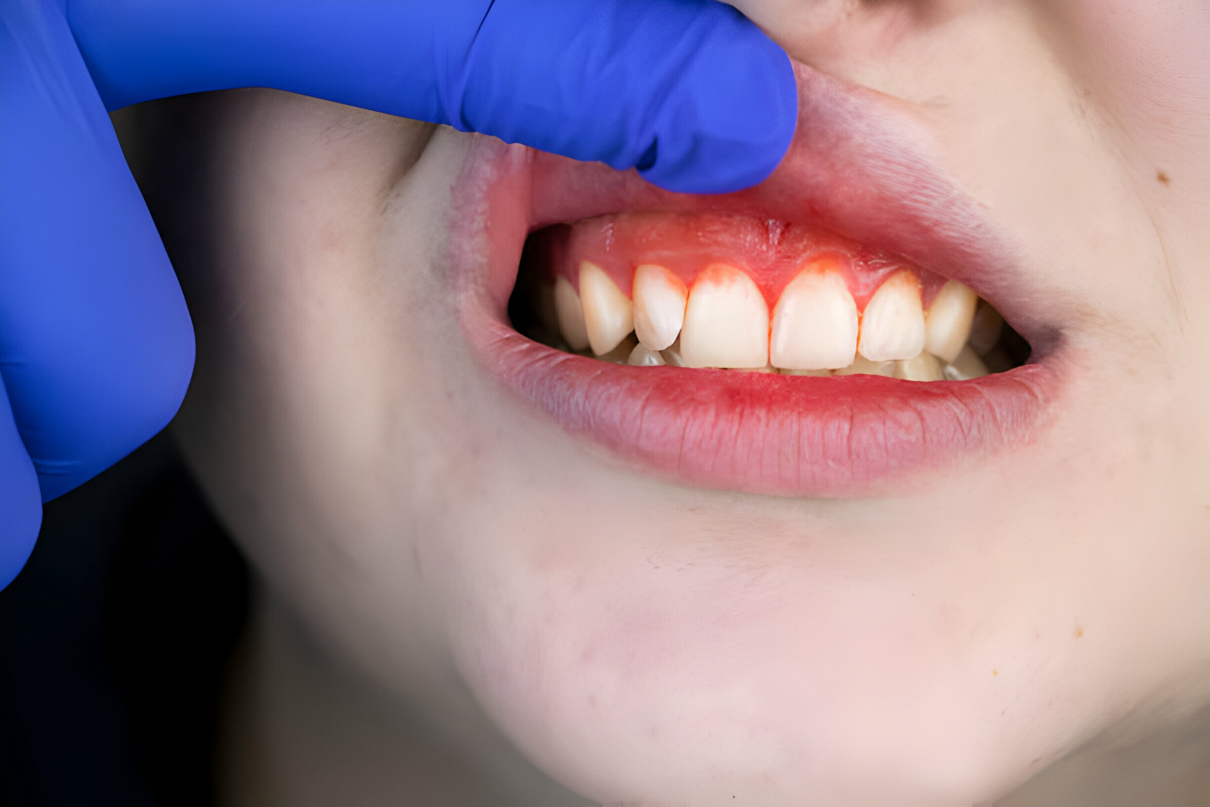 Explore 7 Key Facts About Gum Disease To Improve Your Oral Health_FI