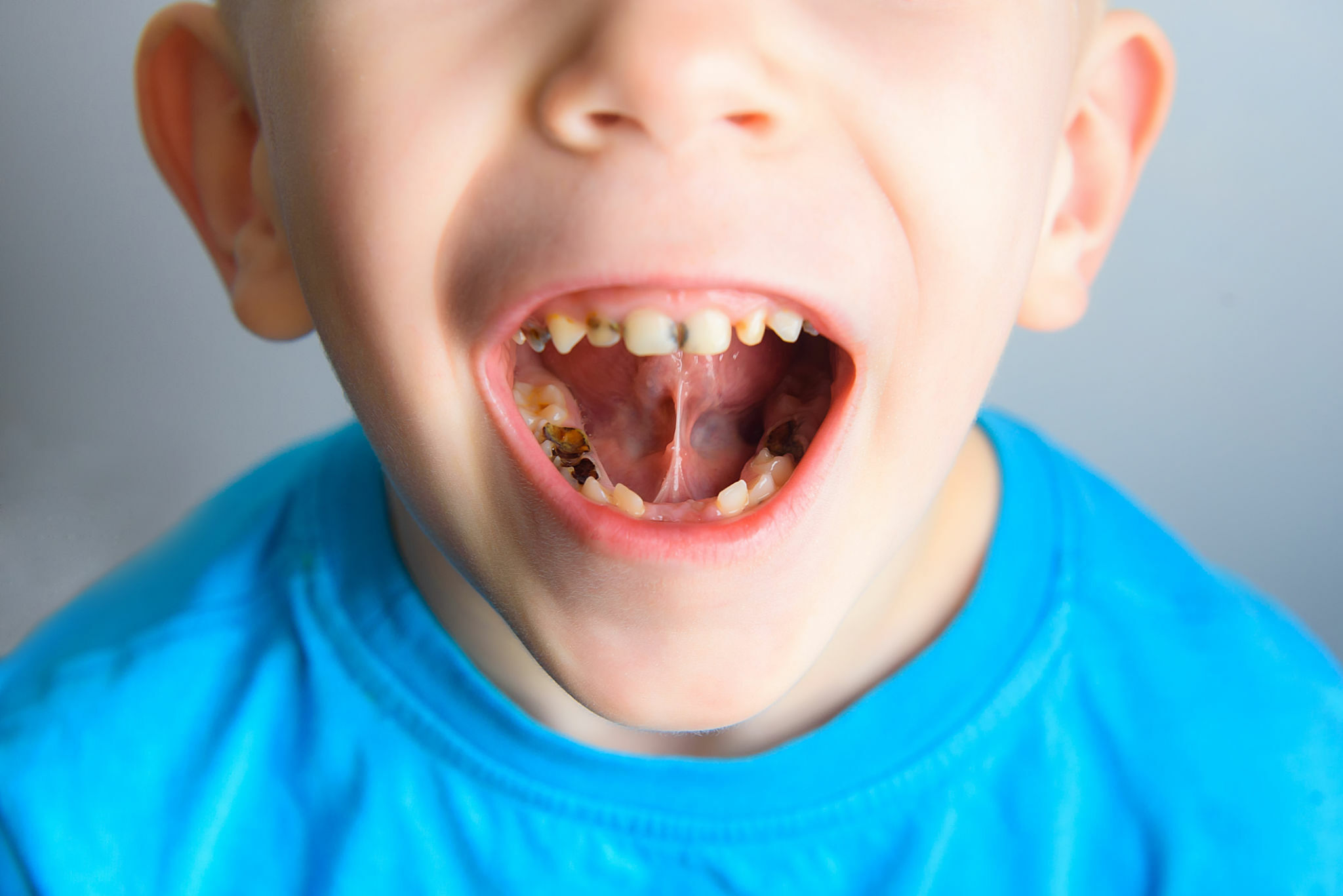 Dos And Don'ts After Tooth Filling: Your Guide To Better Recovery_FI