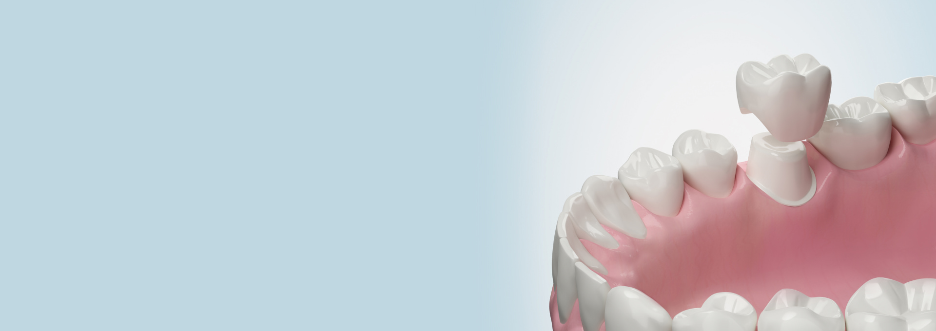 Dental Crowns Banner Image