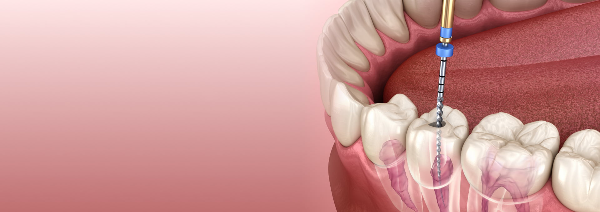 Root Canals Banner Image